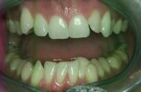 patient 2 teeth before