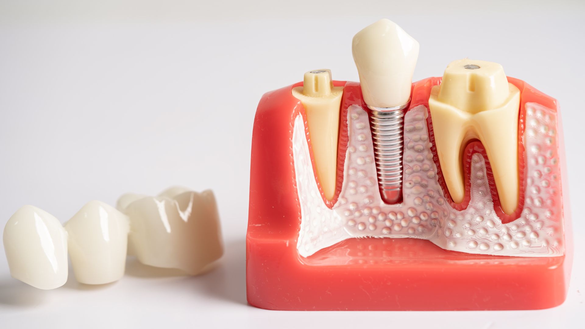 The Complete Guide To Dental Implants In Scottsdale