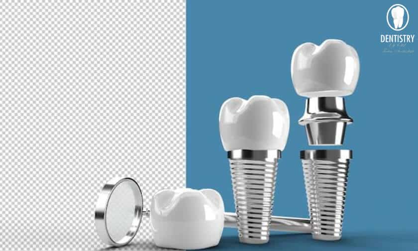 Dental Implants in Scottsdale