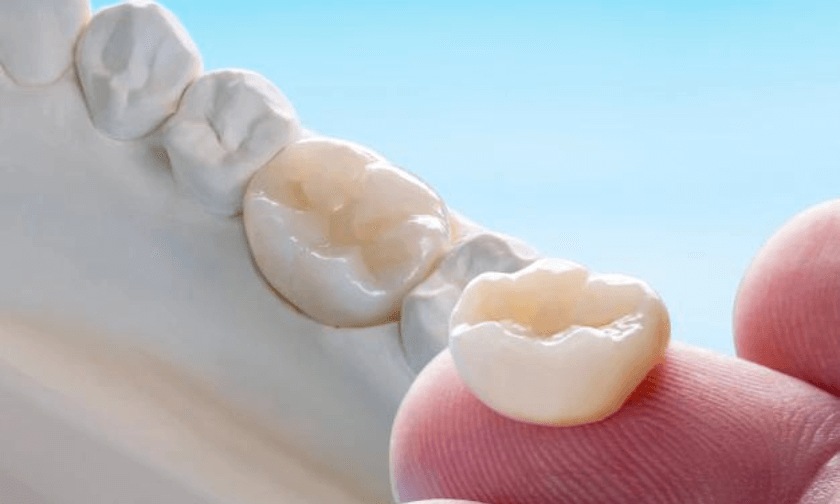 Dental Crowns Scottsdale Dental Crowns Scottsdale