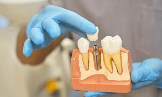 5 Signs You May Need Dental Implants