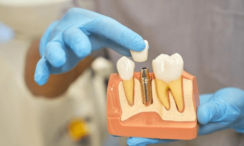 Dental Implants Scottsdale