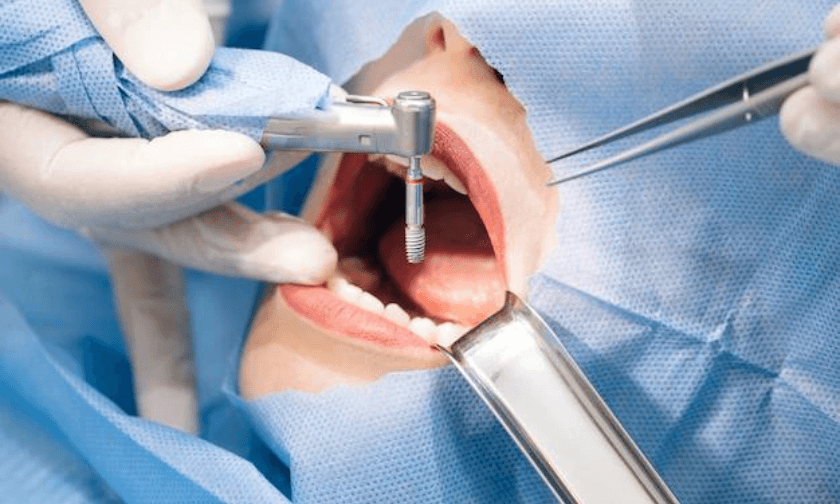Dental Implants Scottsdale