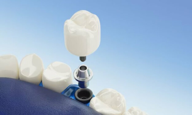 Dental Implants Scottsdale