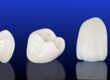 5 Key Facts About Dental Crowns Shared by Our Scottsdale Team