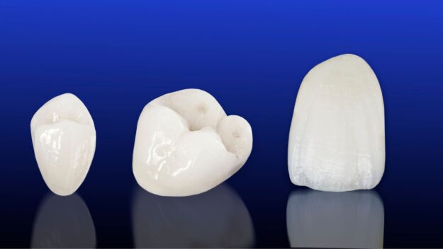 5 Key Facts About Dental Crowns Shared by Our Scottsdale Team