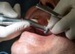Dental Implants in Scottsdale AZ