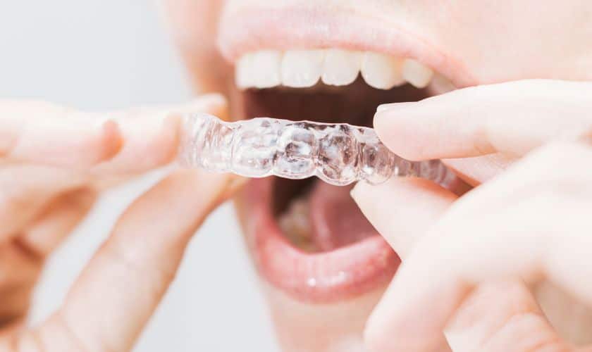 Invisalign Aligners