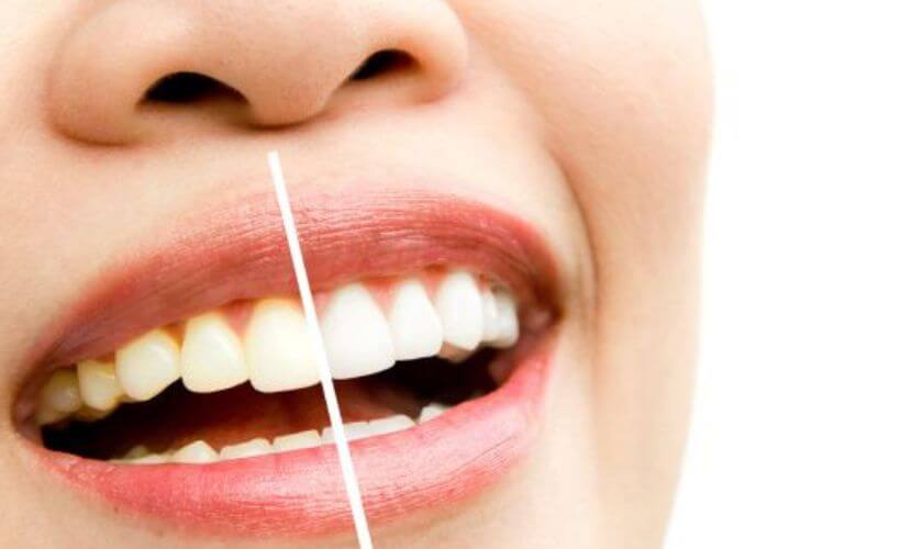 Teeth Whitening in Scottsdale