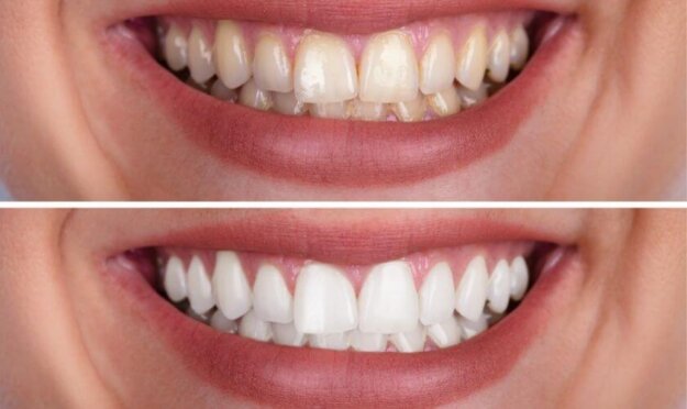 Common Teeth Stains & Whitening Solutions in Scottsdale