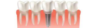 Dental Implants Scottsdale
