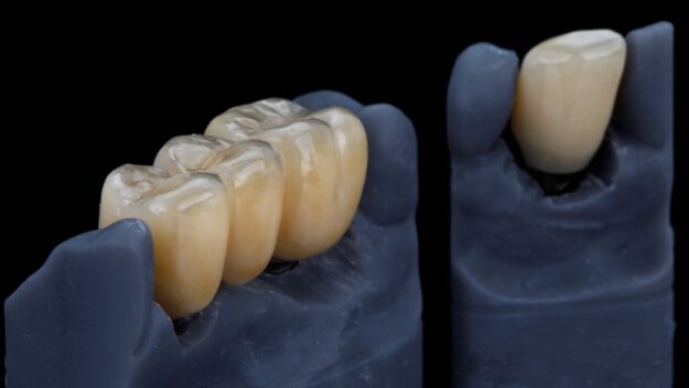 Dental Crowns Scottsdale