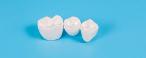 Dental Crowns Scottsdale AZ