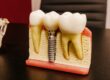 Dental Implant Procedures in Scottsdale