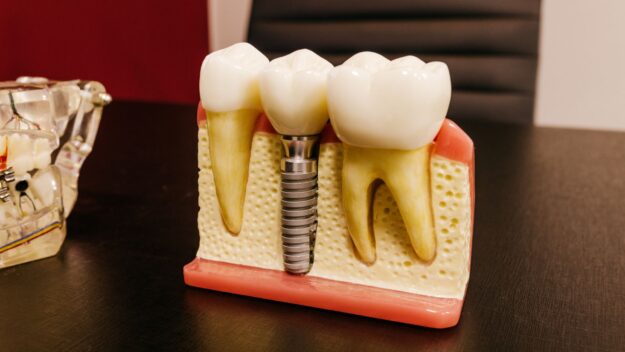 Dental Implant Procedures in Scottsdale Dental Implant Procedures in Scottsdale