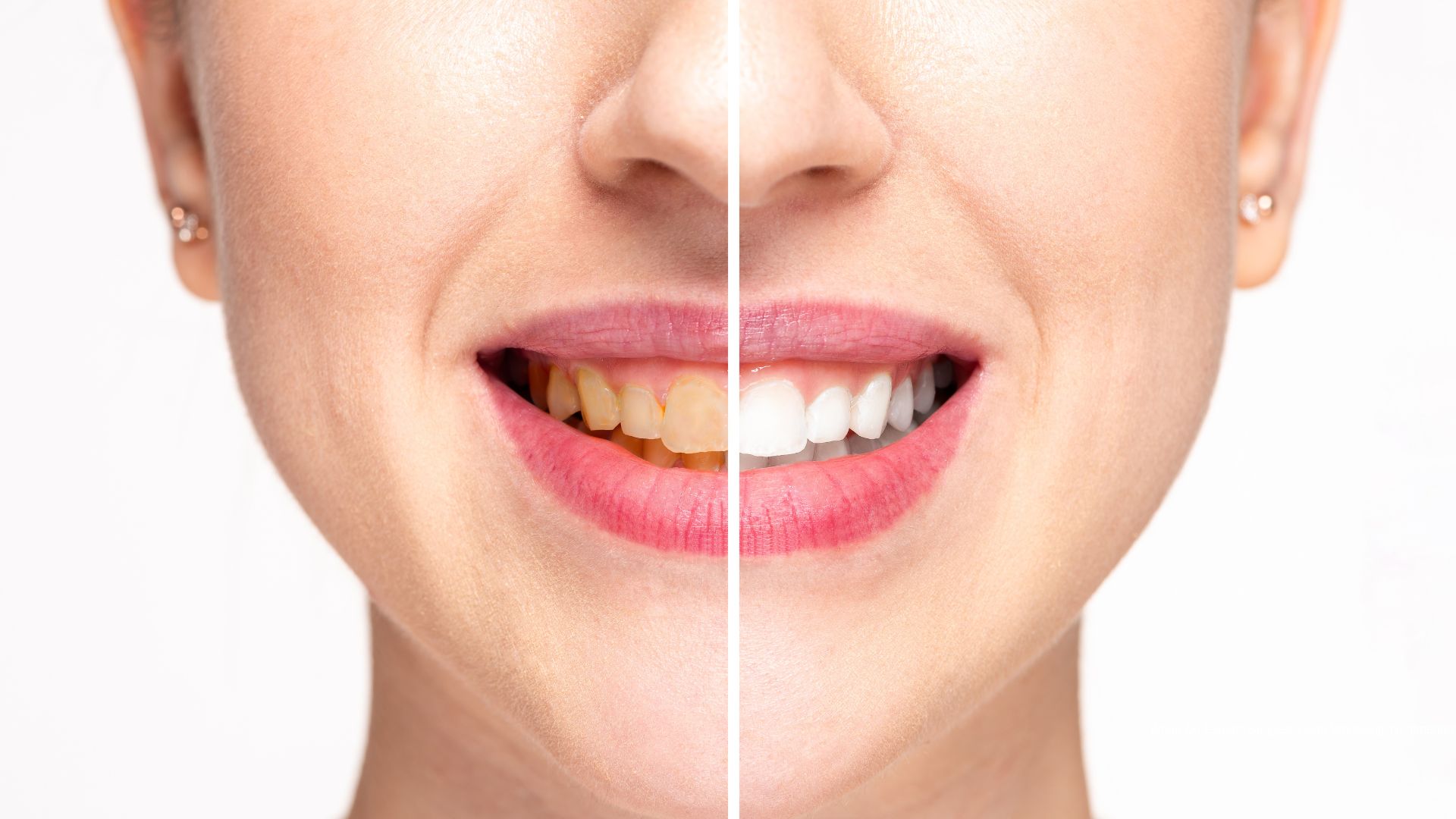 Teeth Whitening Treatments
