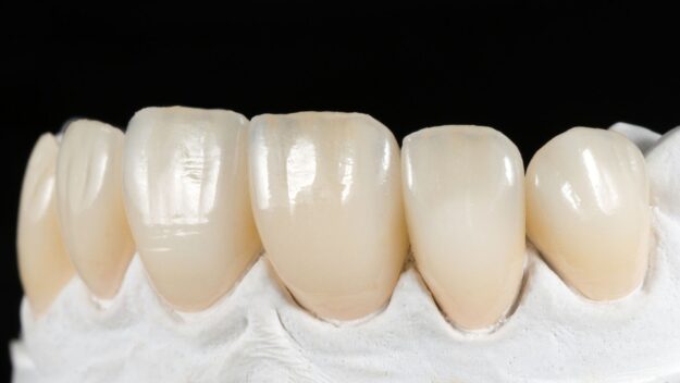 Veneers in Scottsdale Veneers in Scottsdale