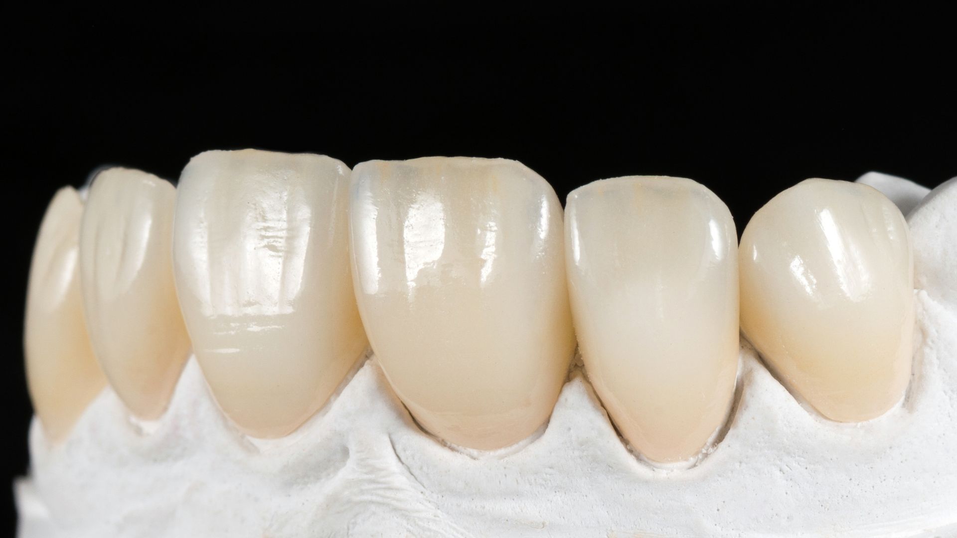 Veneers in Scottsdale