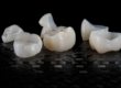 Are Our Dental Crowns in Scottsdale Stronger Than Real Teeth?