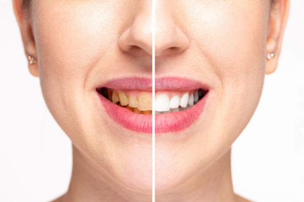 how to get rid of yellow stains on teeth how to get rid of yellow stains on teeth