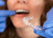 How Long Does Invisalign Take to Work? Timeline Explained by our Scottsdale Expert