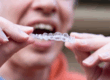 Gum Irritation from Invisalign? Causes & Relief Tips from Scottsdale Team