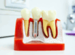 Does a Dental Implant Hurt? Know What to Expect from Our Scottsdale Team