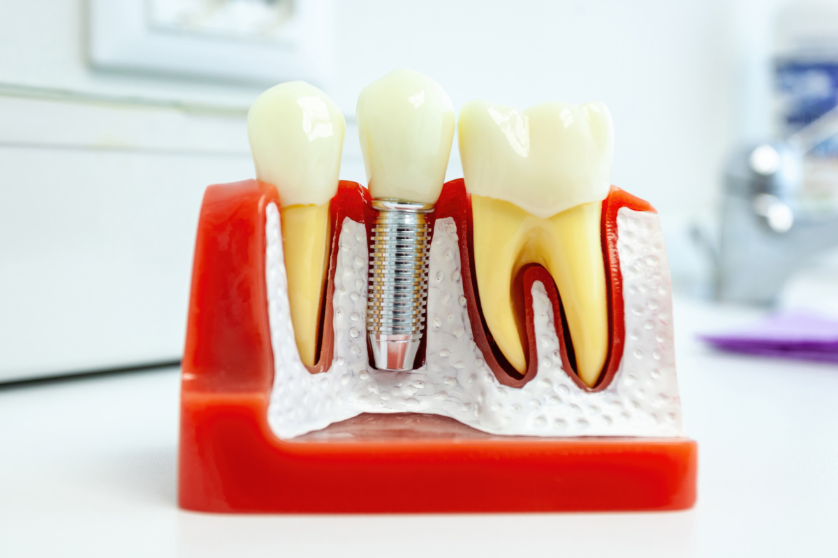 Does a Dental Implant Hurt? Know What to Expect from Our Scottsdale Team