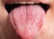 Bumps on Your Tongue