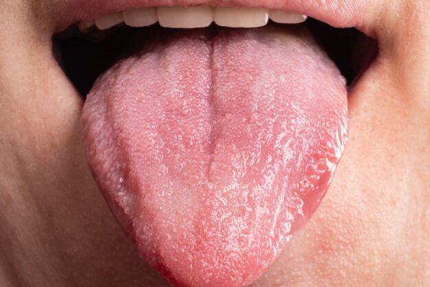 Bumps on Your Tongue