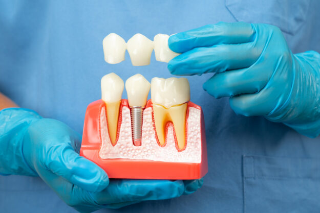 Dental Implants Scottsdale