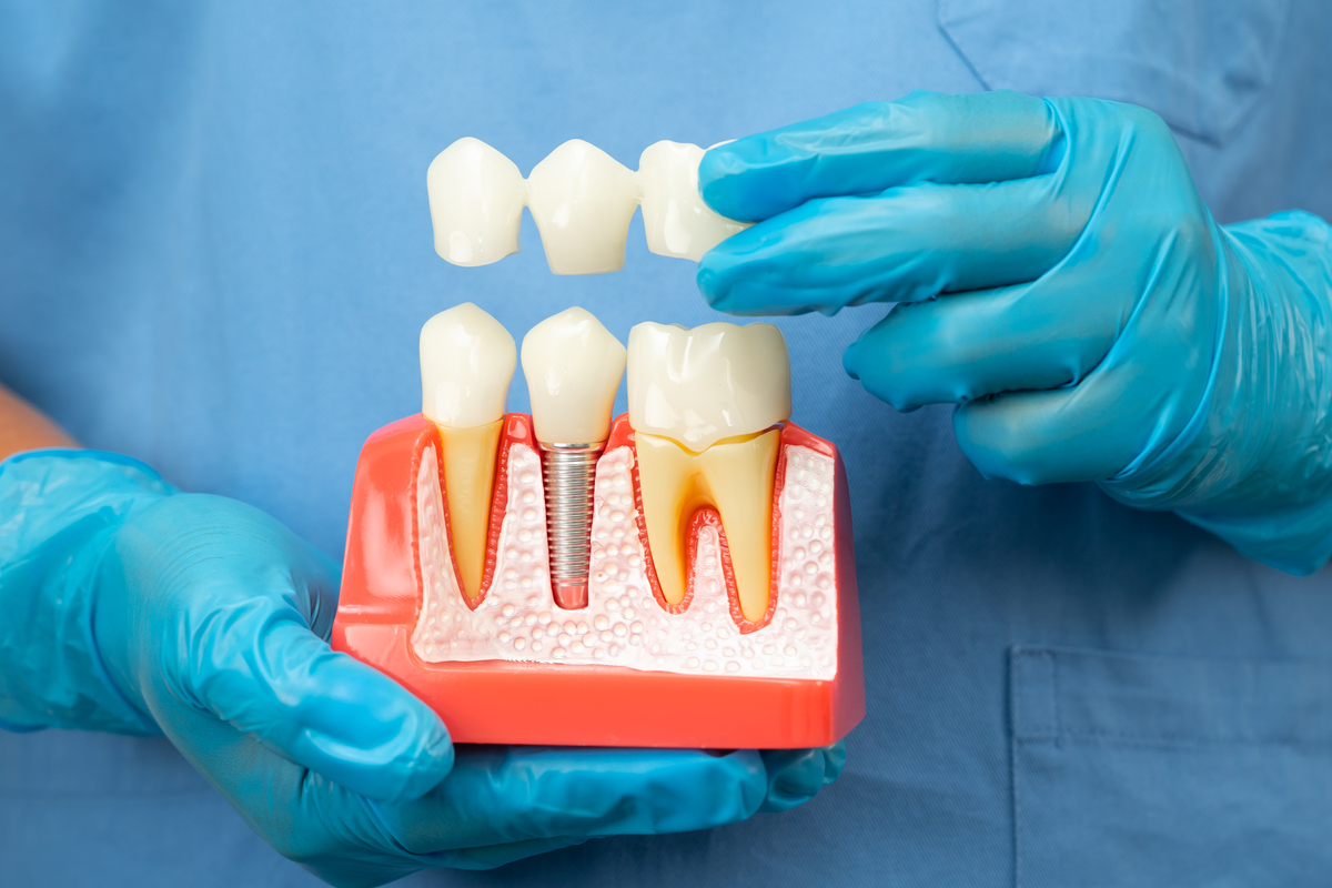 Dental Implants Scottsdale