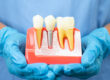 Dental Implants Scottsdale