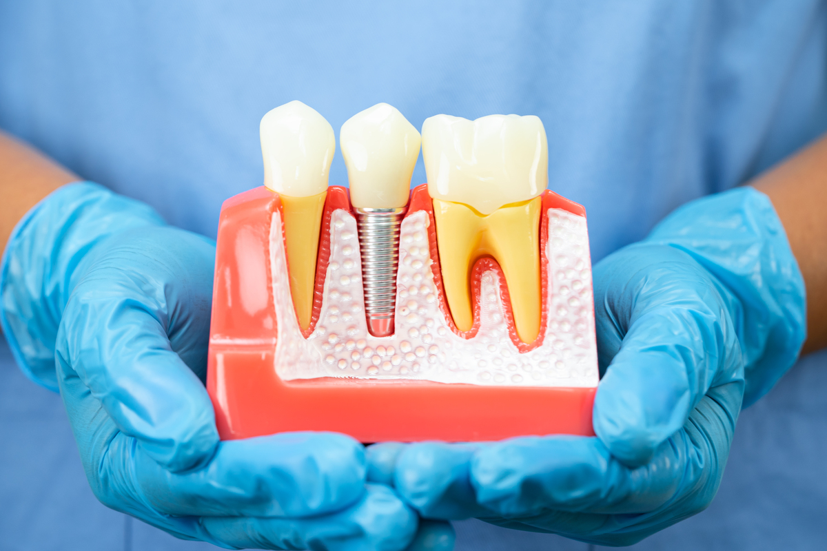Dental Implants Scottsdale