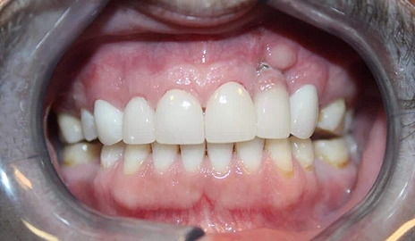 Close up of a patient's teeth after a smile transformation procedure at Dentistry of Old Town Scottsdale