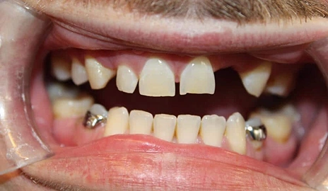 Close up of a patient's teeth before a smile transformation procedure at Dentistry of Old Town Scottsdale