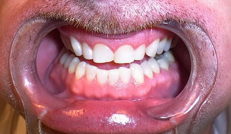 Close up of a patient's teeth after a smile transformation procedure at Dentistry of Old Town Scottsdale