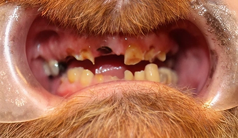 Close up of a patient's teeth before a smile transformation procedure at Dentistry of Old Town Scottsdale
