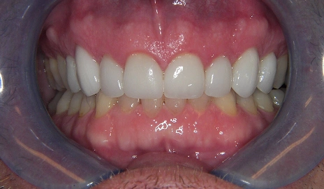 Close up of a patient's teeth after a smile transformation procedure at Dentistry of Old Town Scottsdale