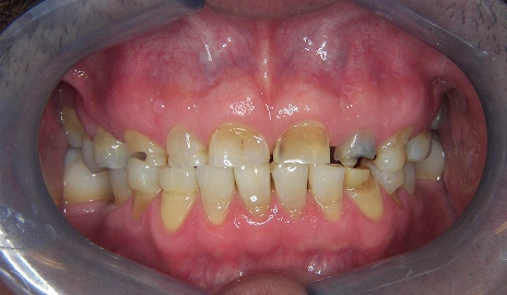 Close up of a patient's teeth before a smile transformation procedure at Dentistry of Old Town Scottsdale