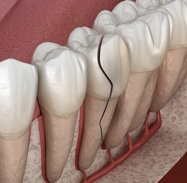 Illustration of a cracked tooth showing the tooth structure representing cracked tooth treatment options in Scottsdale