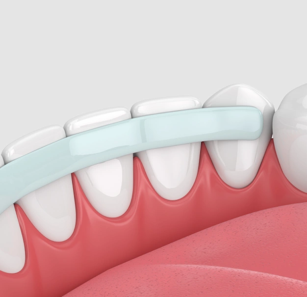 Illustration of dental bonding material being applied to a tooth representing cosmetic dental bonding in Scottsdale