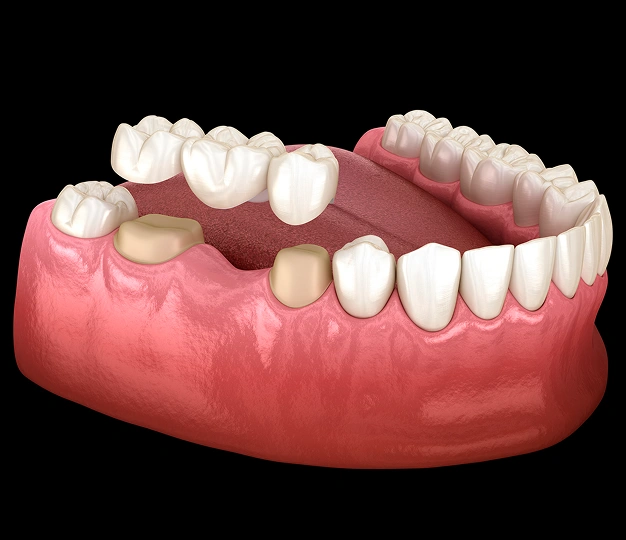 Detailed model of a dental bridge showing the crowns on a gum model representing dental bridge services in Scottsdale