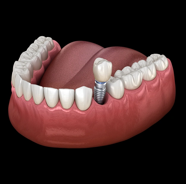 Detailed illustration of a dental implant with a crown on a dark background representing implant services at Dentistry of Old Town Scottsdale