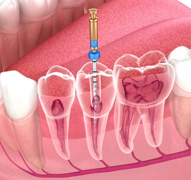 Illustration of an endodontic root canal procedure showing the tooth and treatment process at Dentistry of Old Town Scottsdale
