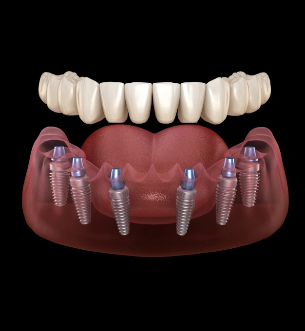 Dental model showing implant retained dentures representing full arch implant denture services at Dentistry of Old Town Scottsdale