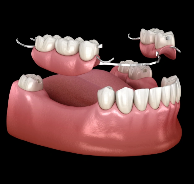 Dental model showing implant retained partial dentures on a black background representing partial denture services in Scottsdale