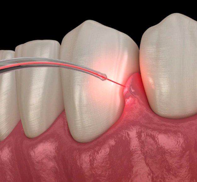 Illustration of a dental laser being used on a tooth representing laser therapy dental treatments in Scottsdale