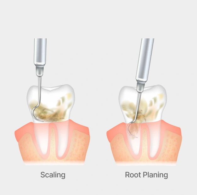 Dental implant tool models representing scaling and root planing periodontal treatment at Dentistry of Old Town Scottsdale