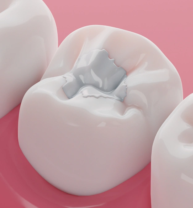 Pink illustration of a tooth with a white tooth colored filling representing BPA free filling services in Scottsdale